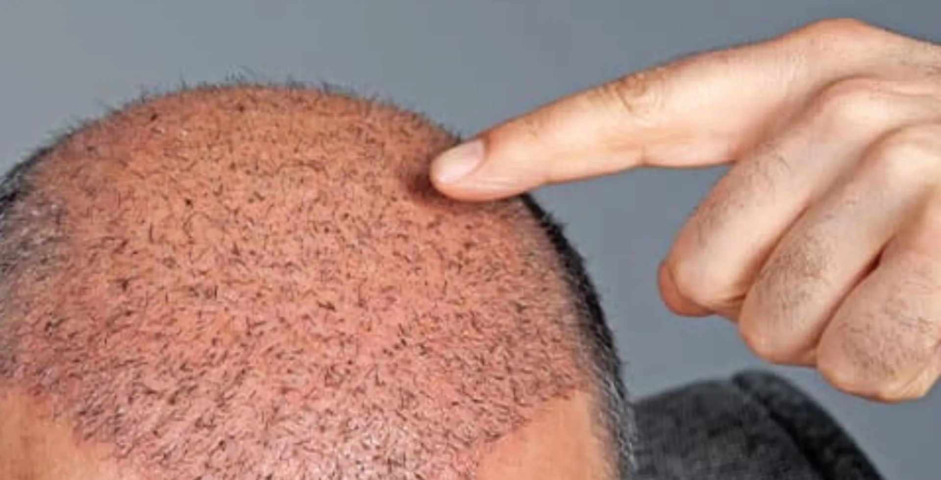 hair transplant turkey the ultimate destination for hair restoration