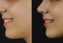 choosing the best reputation rhinoplasty surgeon for your aesthetic transformation