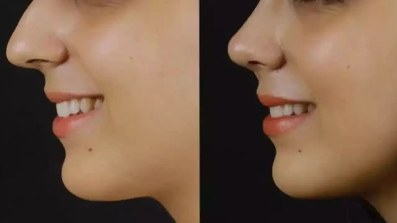 choosing the best reputation rhinoplasty surgeon for your aesthetic transformation